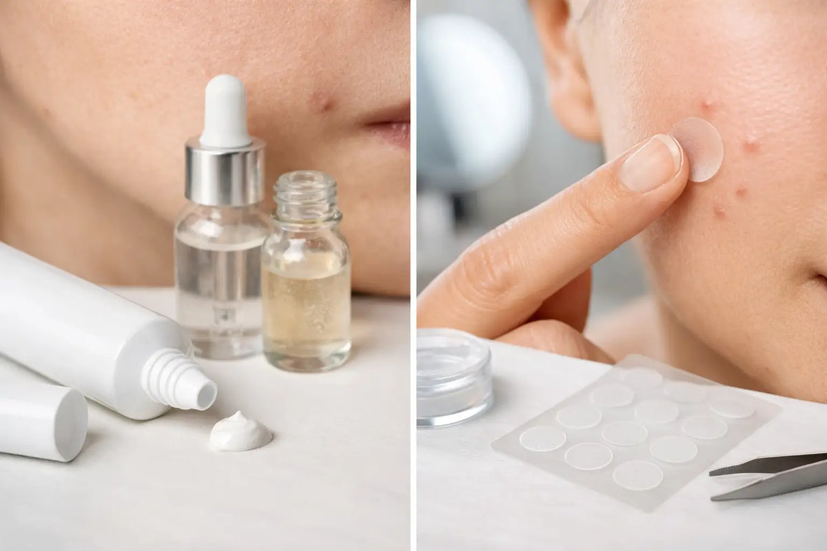 Spot Treatment vs Pimple Patches: Which Works?